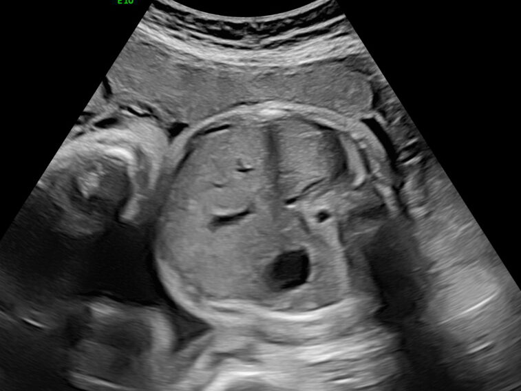 胎児エコー画像